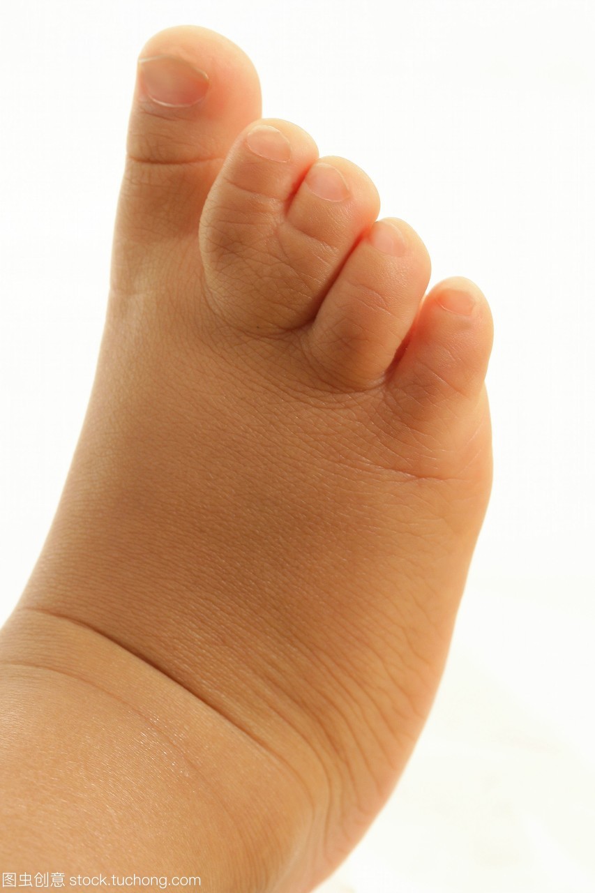 1歲到10歲,混血,科技醫(yī)療,1 to 10 years old,小孩,男孩,腳,嬰兒,男人,1歲到5歲,一個,孩子,小孩子,腳趾,人,肢體,稚子,醫(yī)學,下肢,1 to 5 years old,快樂童年,people,toe,man,lower limb,boy,baby,medicine,one,mixed origins,foot,congenital condition,genetic disease,syndactyly,malformation,bsip,limb