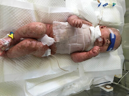 哈市兒童醫(yī)院重癥醫(yī)學科成功救治先天性大皰表皮松解癥重患 _新浪黑龍江_新浪網